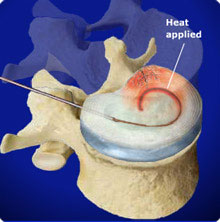 click to watch an animated Electrothermal Therapy procedure