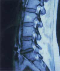 xray of spinal stenosis