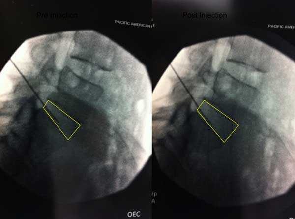 x-ray of an L5-S1 Disc Pre Biostat injection, and Post Biostat injection